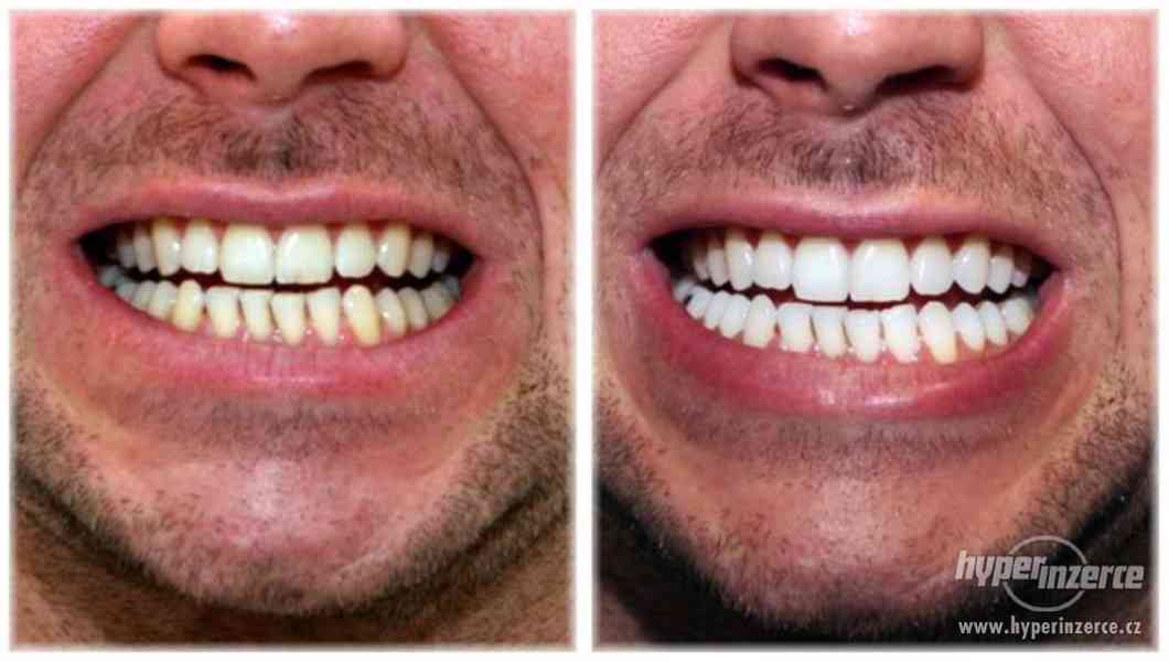 Profesionální gel na bělení zubů 35%karbamid peroxid - foto 1