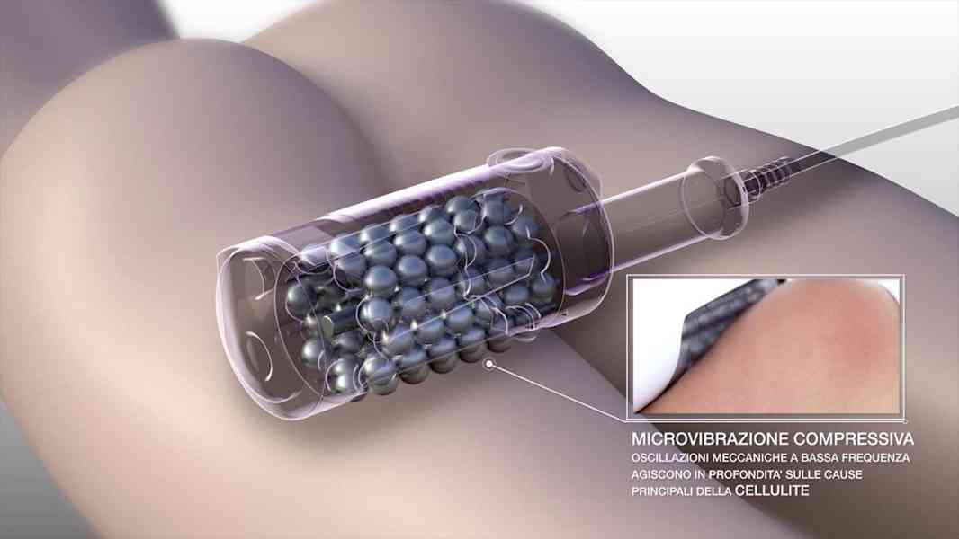 Přístroj Endospheres Therapy AK BODY - patentovaná technolog