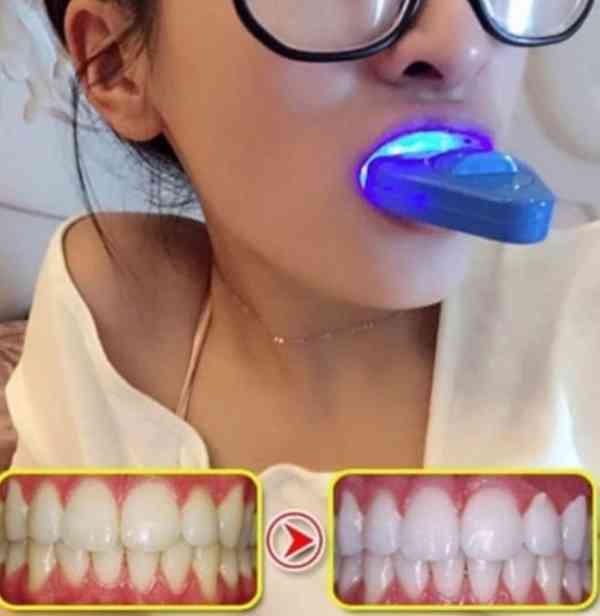 Sada na bělení zubů+Gel  - foto 2