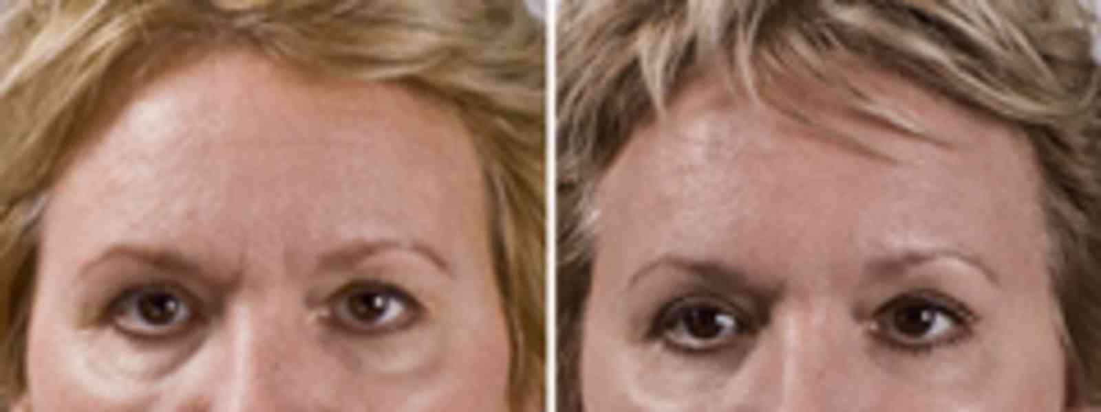 Náplast na vrásky - Facial Patches Frownies - foto 4